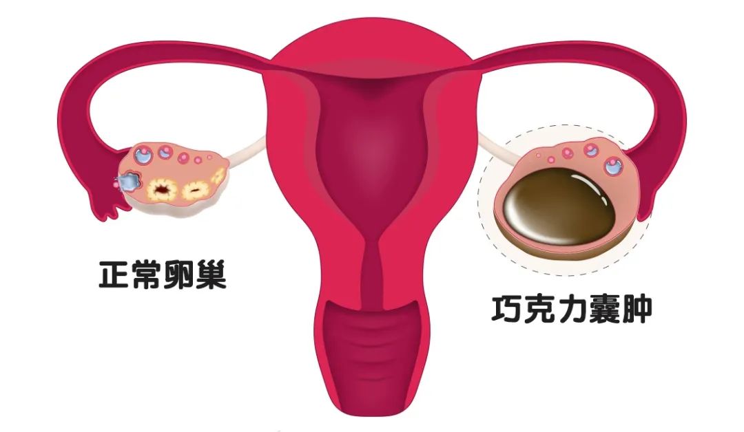 一来月经就痛经是什么原因,经期咯血