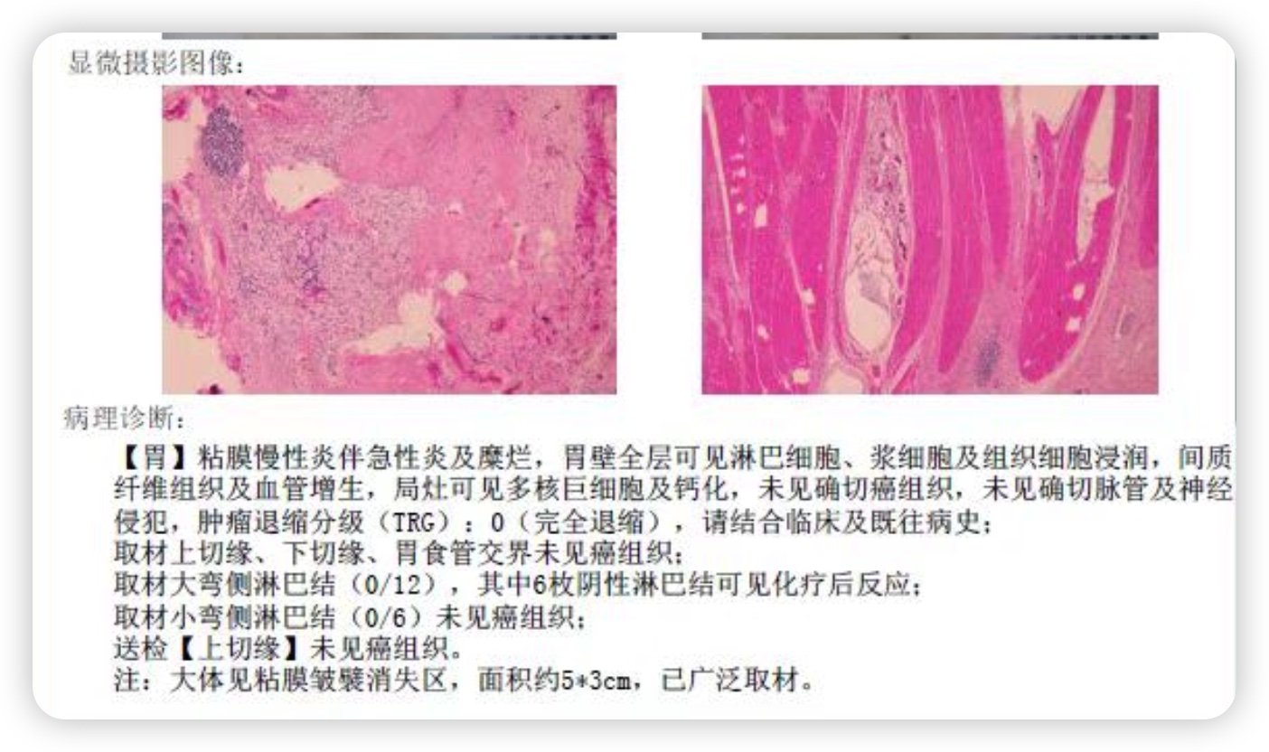助力癌症康复,胃癌晚期转化治疗成功案例