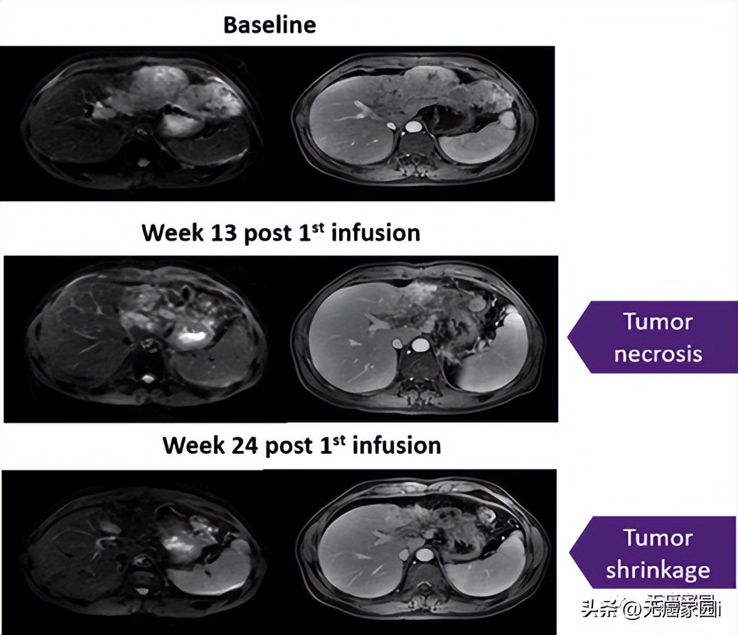 tcr-t疗法可以治疗哪些肿瘤,tcr-t细胞疗法成功率