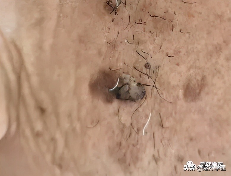 黑痣破溃出血出现丘疹是癌变吗,皮肤上的黑痣变癌的概率多大