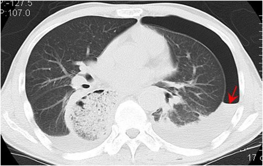 自发性气胸会自己好吗,自发性气胸会不会自己好