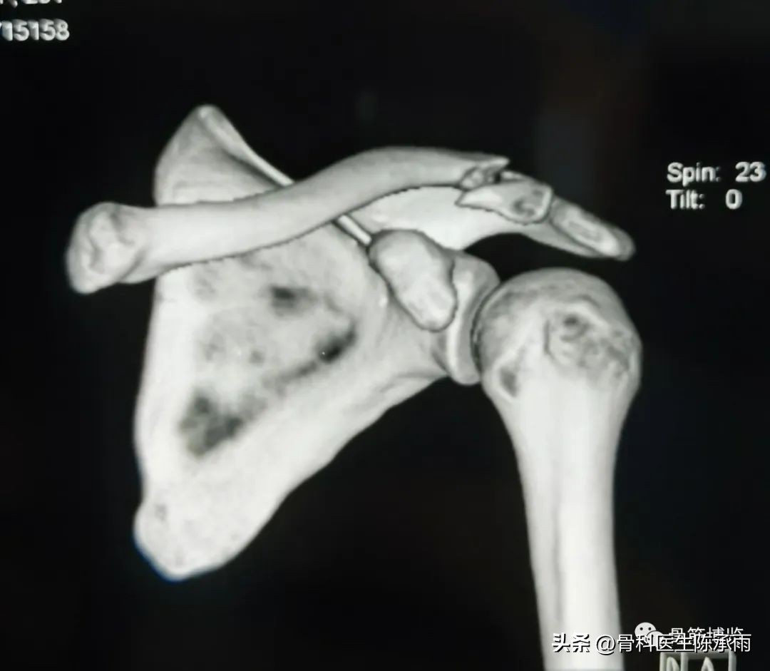 锁骨骨折保守治疗肩关节康复训练,肩锁骨远端骨折保守治疗要多久