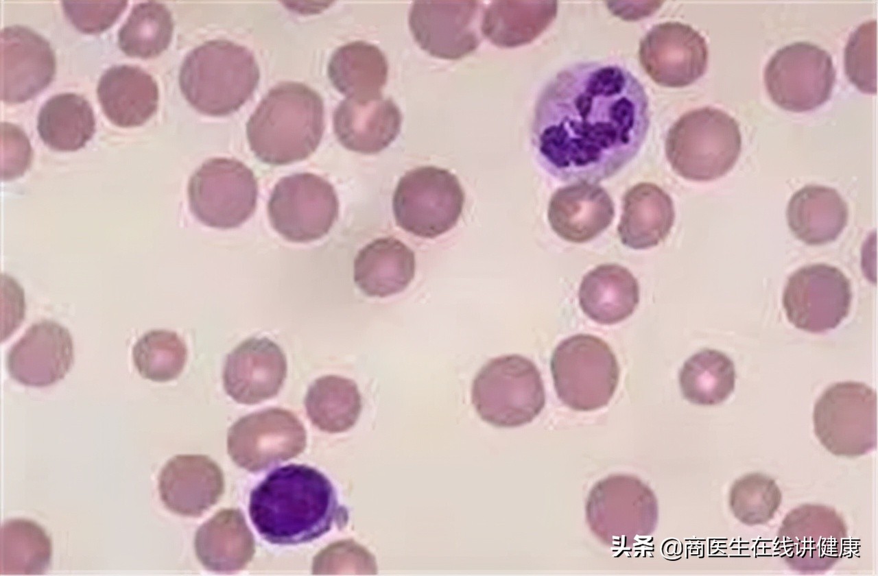 糖尿病人用甲钴胺好还是用b12好,糖尿病神经病变吃甲钴胺还是b12