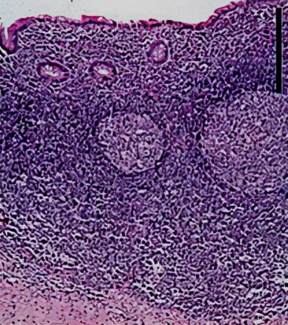 怀孕早期发现有阑尾炎怎么办,怀孕得阑尾炎怎么办胎儿能要吗