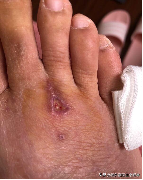 拇外翻手术拆线后伤口干裂怎么办,拇外翻术后肿得厉害怎么办