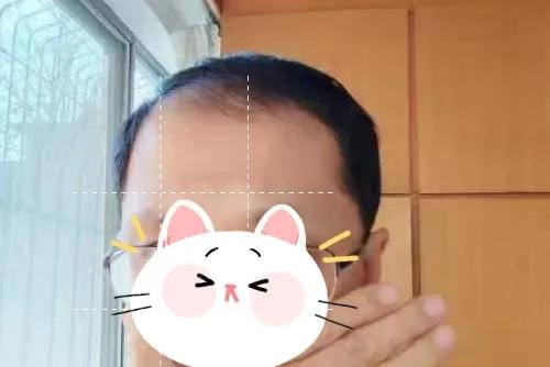 白头发除了可以染色还可以试试假发，亲身经历总结8个热点问题