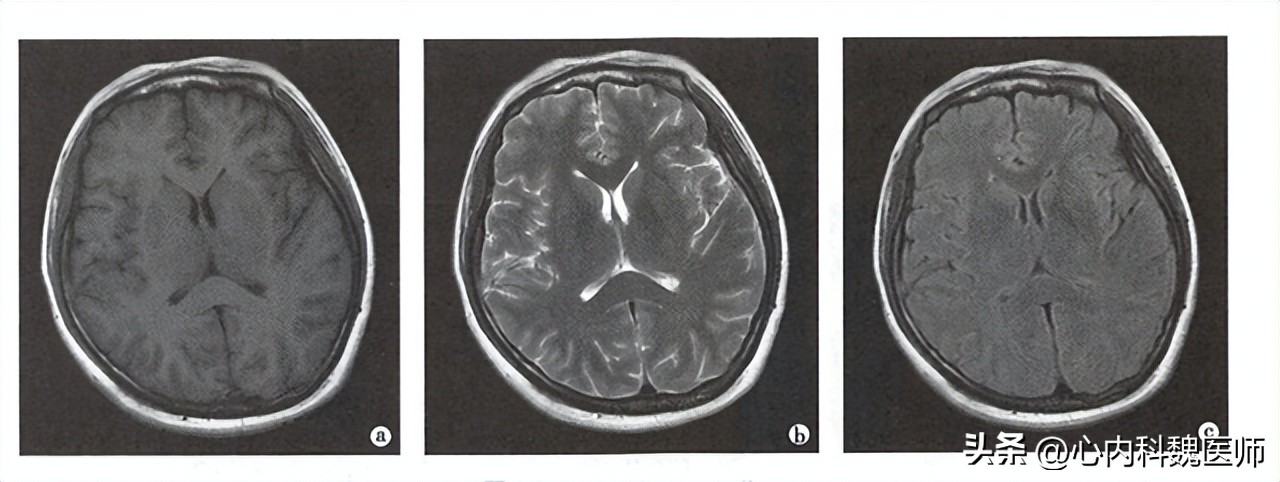 什么是磁共振检查的缺点,磁共振检查注意事项图片