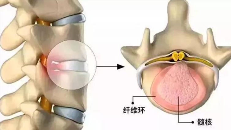 腰椎间盘突出做手术哪种方法更好,腰椎间盘突出医生都会建议做手术