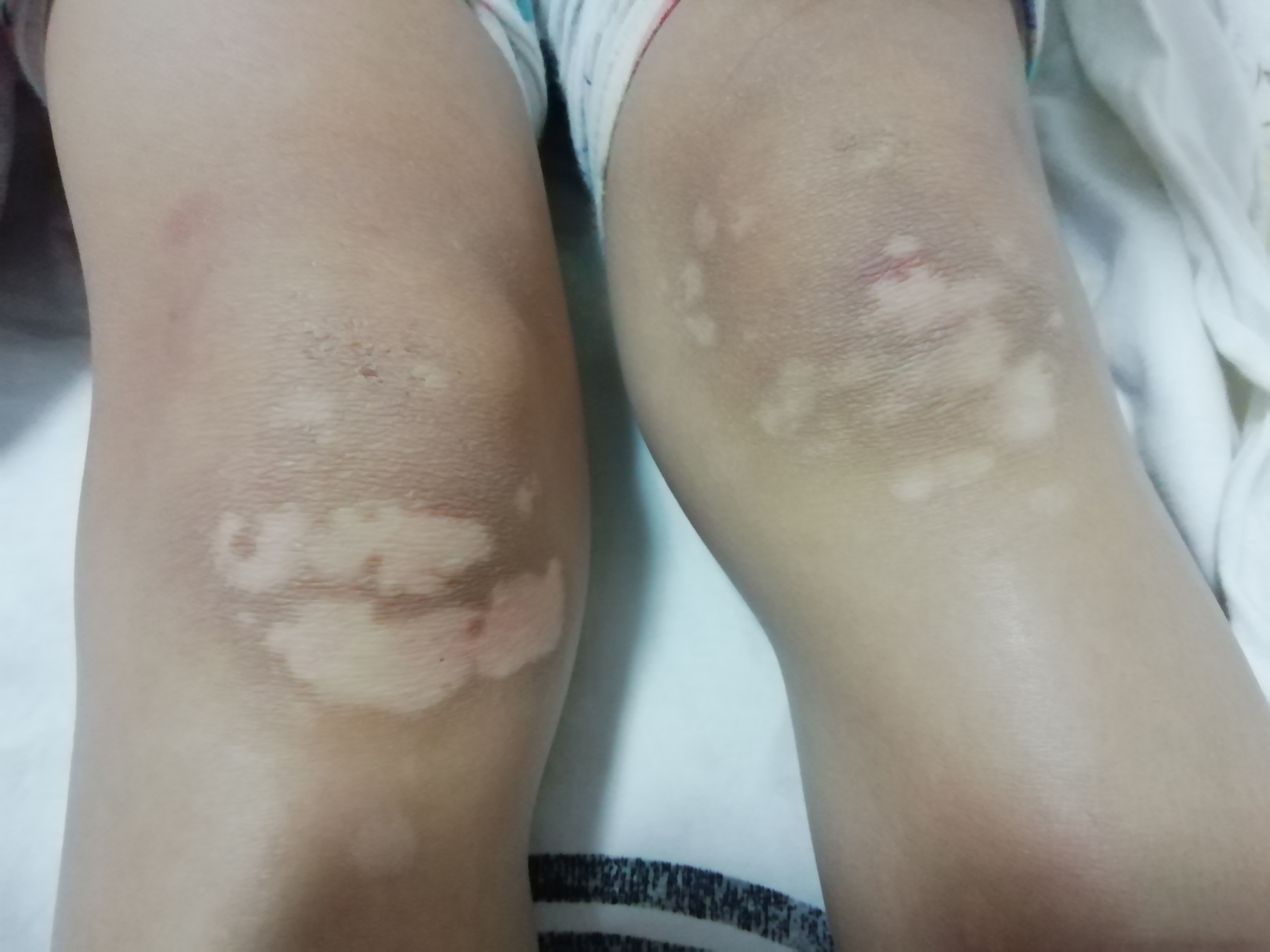 白癜风发现时从什么部位开始发现,各个部位白癜风哪里最好治疗