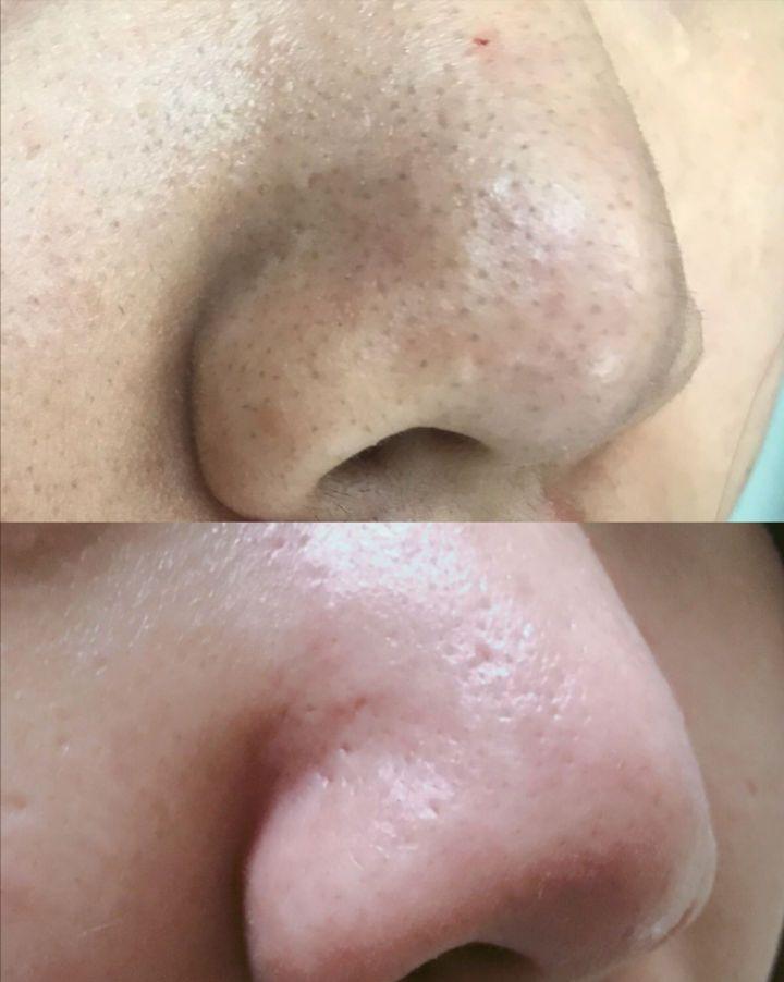 鼻子上有白白的小点可以挤吗,鼻子上黑黑的小点点怎么去除