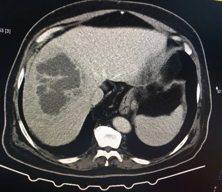 反复发热与什么有关,反复发热是什么病的前兆
