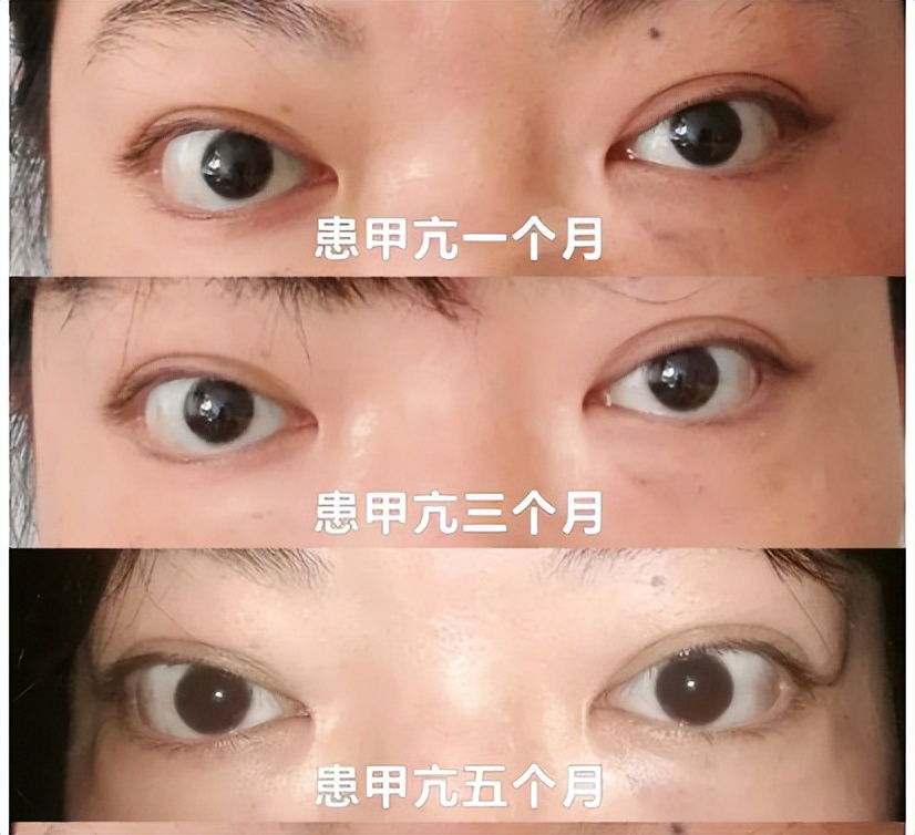 甲亢突眼怎么越治越严重了,甲亢引起突眼的治愈案例