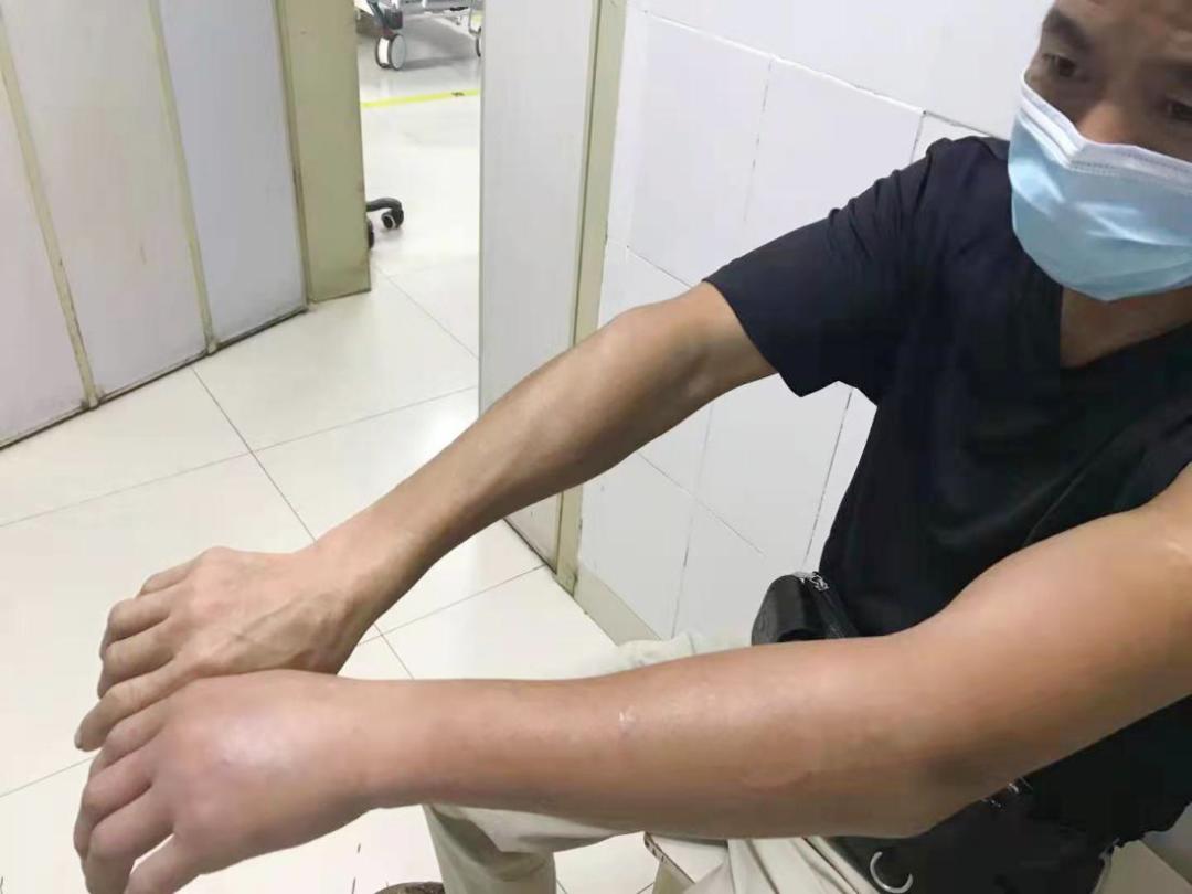 蜂蜇伤如何处理,蜂蜇伤最佳处理方法