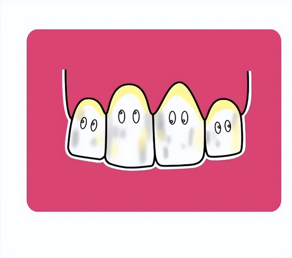 孩子牙齿黑色素沉着怎么去除,牙齿有黑点是色素沉着还是龋齿