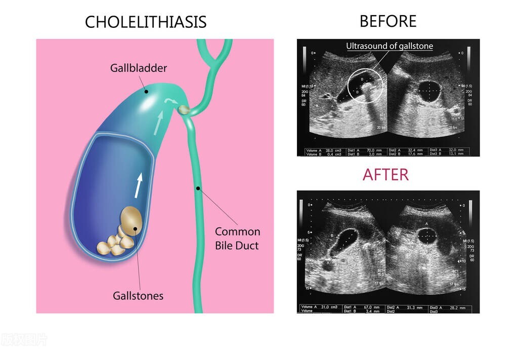 发现胆结石，并非一定要手术，这4类患者，中医保守治疗更合适