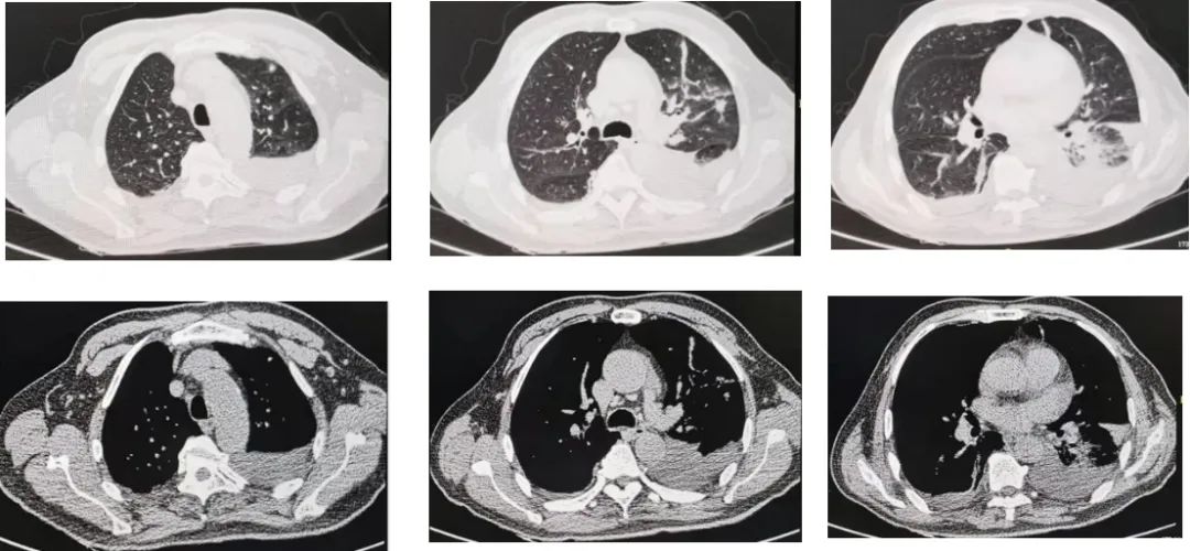 反复发烧但是拍片显示轻微肺炎,一直高烧39-40是肺炎么