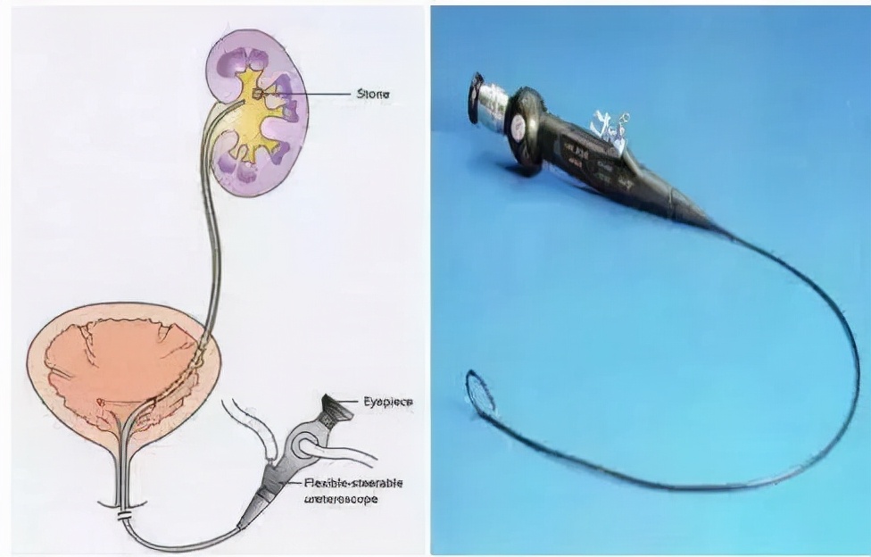 肾结石不疼不代表没有危害，一旦发现要及时就诊！