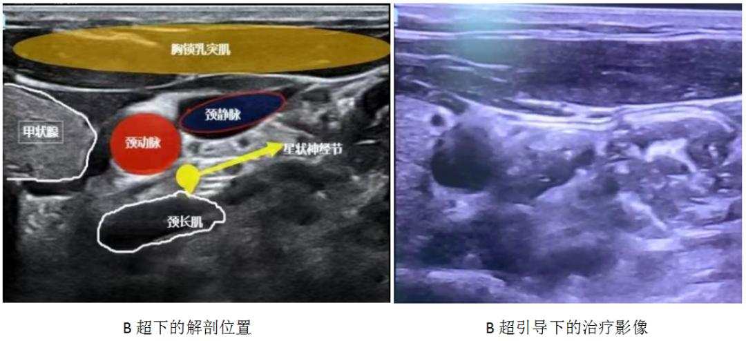 怎样治愈头痛失眠,快速缓解失眠头疼