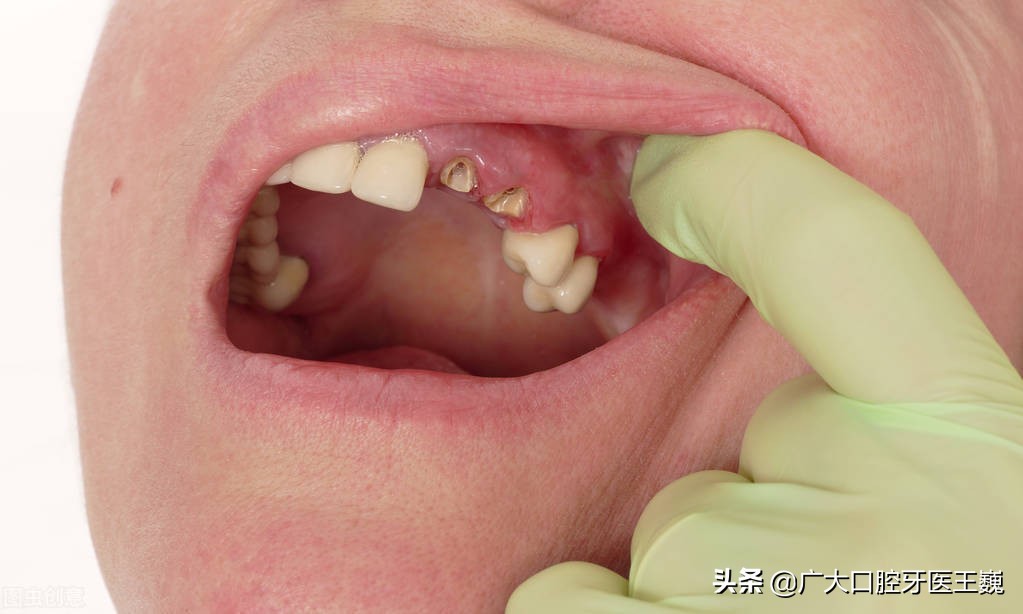 牙龈肿胀发炎疼痛吃什么药,牙龈发炎疼痛是怎么回事