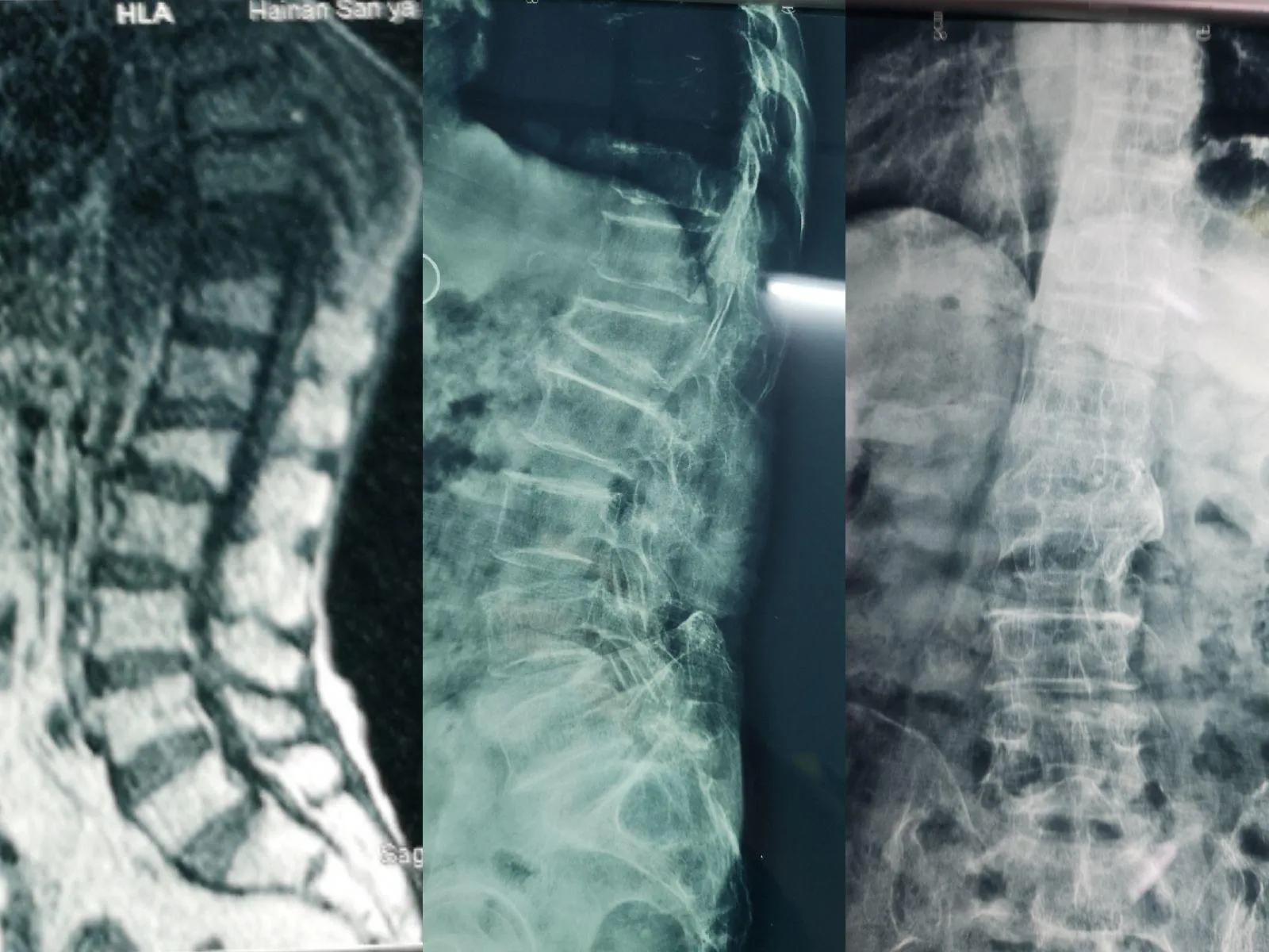 大腿骨折能不能用骨水泥粘住,神奇骨水泥