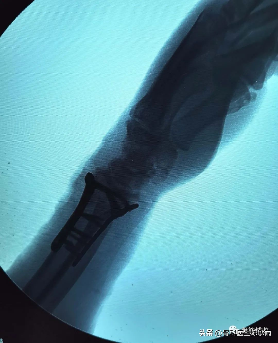 桡骨远端骨折伸直型的复位及固定,掌骨骨折外固定支架恢复