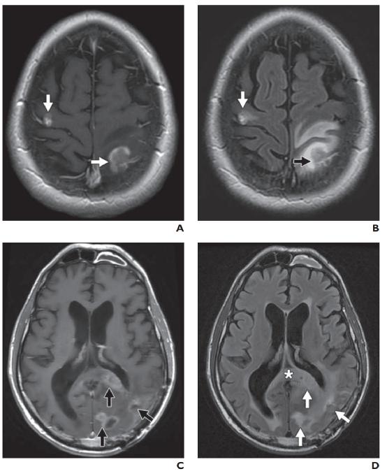 脑水肿的影像,脑水肿形成机制生理学