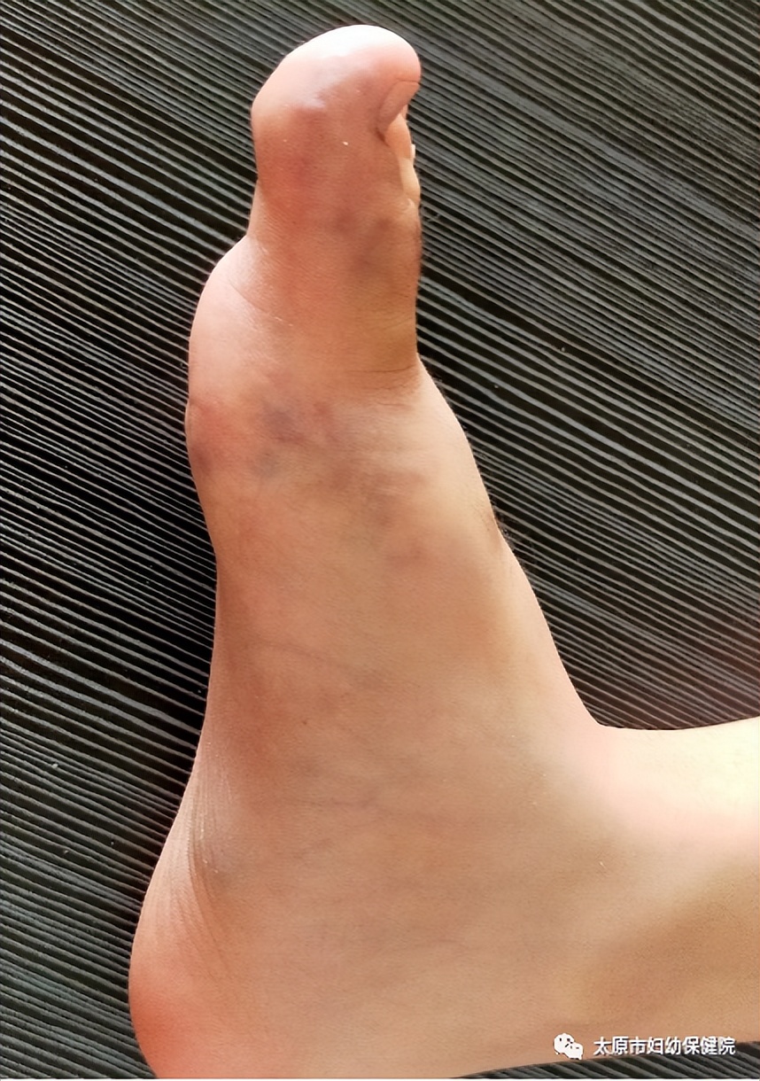 西安哪个医院治静脉畸形比较好,沈阳治疗静脉畸形