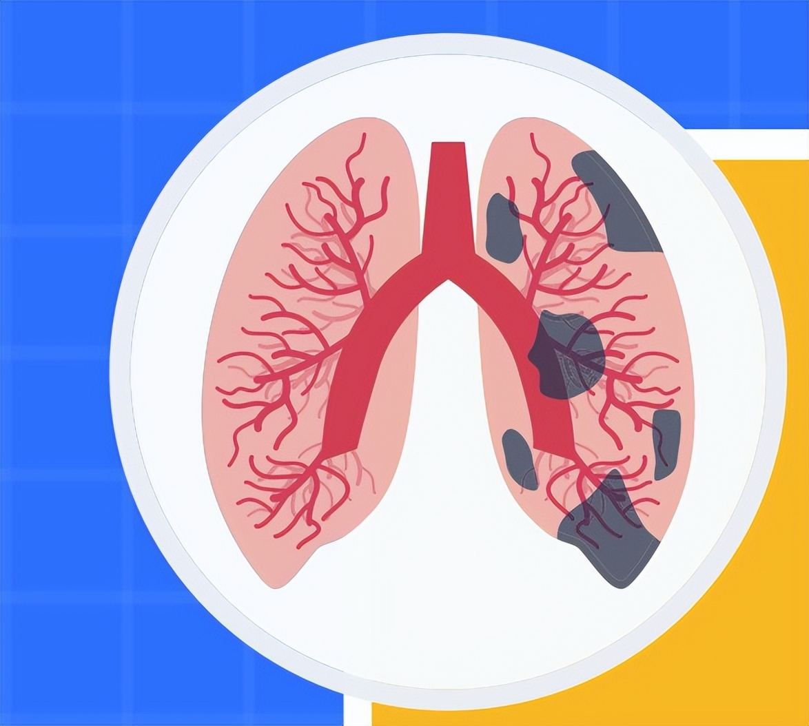 “大白肺”与中药调理——文摘（有人咨询大白肺的中药调理）