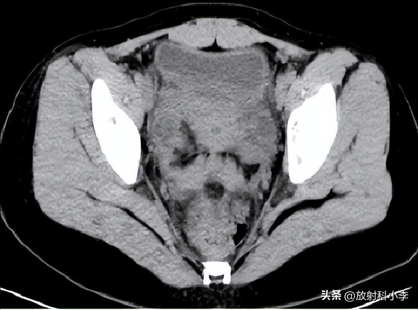 妇科急腹症的ct表现,妇科急腹症的诊断与治疗