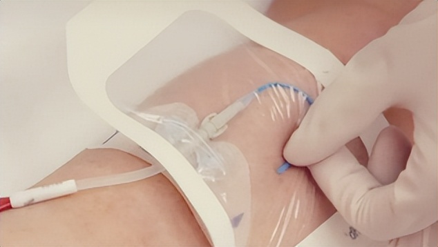 picc贴膜过敏怎么办,picc贴膜下皮肤起红疹原因