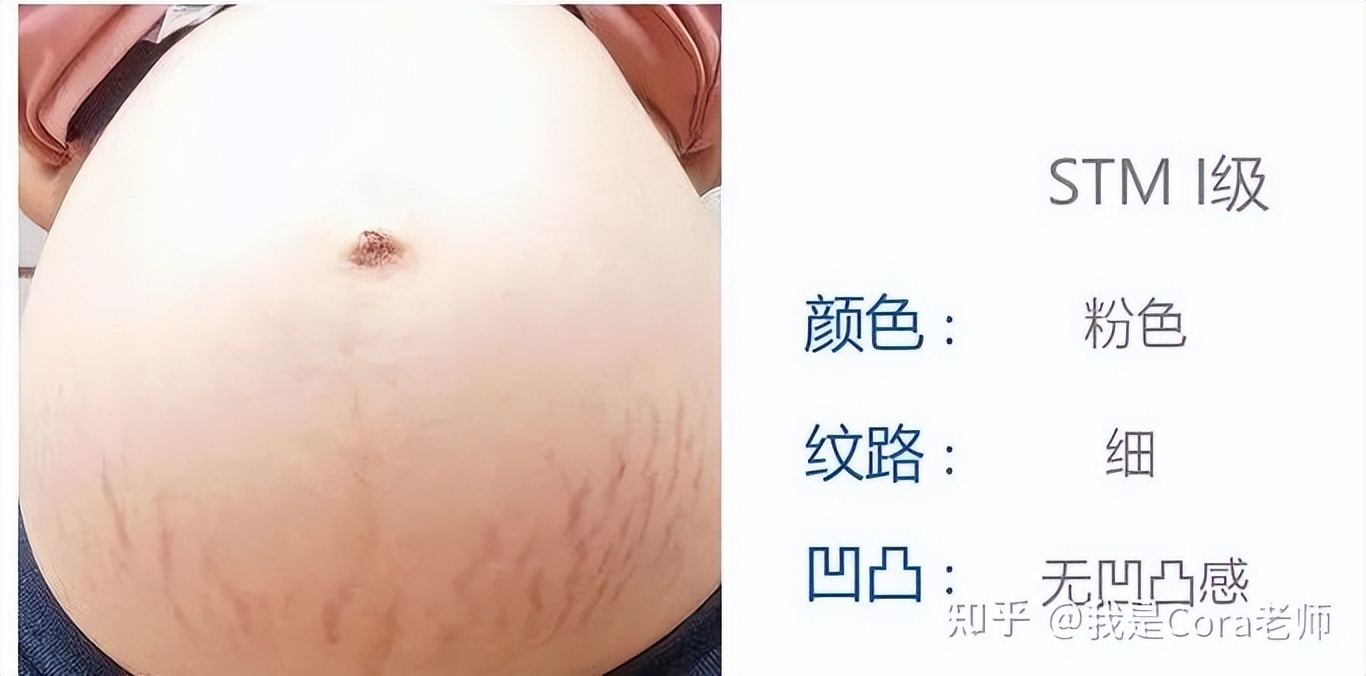 妊娠纹用什么方法可以修复,妊娠纹可以修复吗