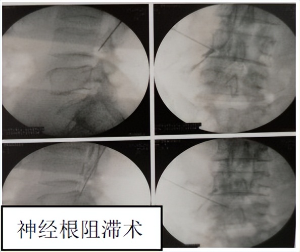 骨科必看的科普｜|得了腰椎间盘突出症，选择何种治疗方式才好？