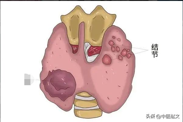 吃什么可以消囊肿结节,长了囊肿吃中药有什么治疗方法吗