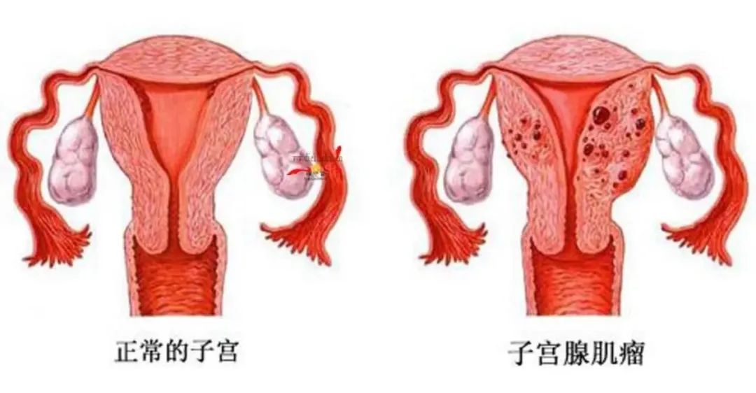 得了子宫腺肌症必须切除子宫吗,子宫腺肌症严重了只能切除子宫吗
