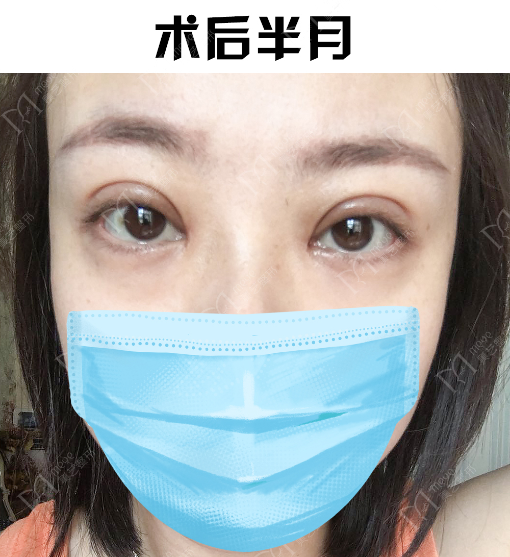 我做了双眼皮下眼睑会肿怎么回事,做了双眼皮十天肉条感严重怎么办