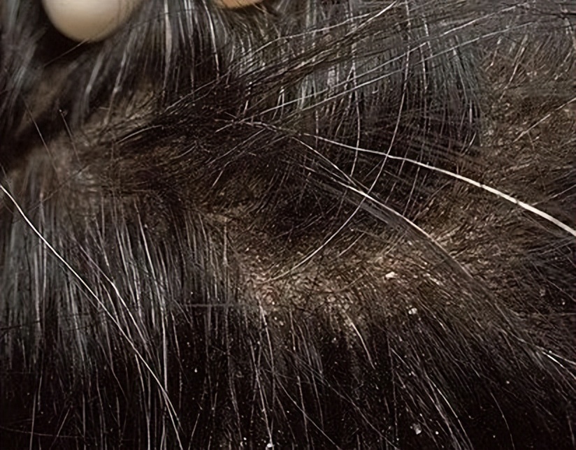 指甲抓头皮有白色的泥,头皮总能抠下来白泥