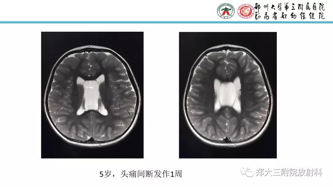 透明隔腔主要是判断什么,透明隔腔宽约10mm什么意思