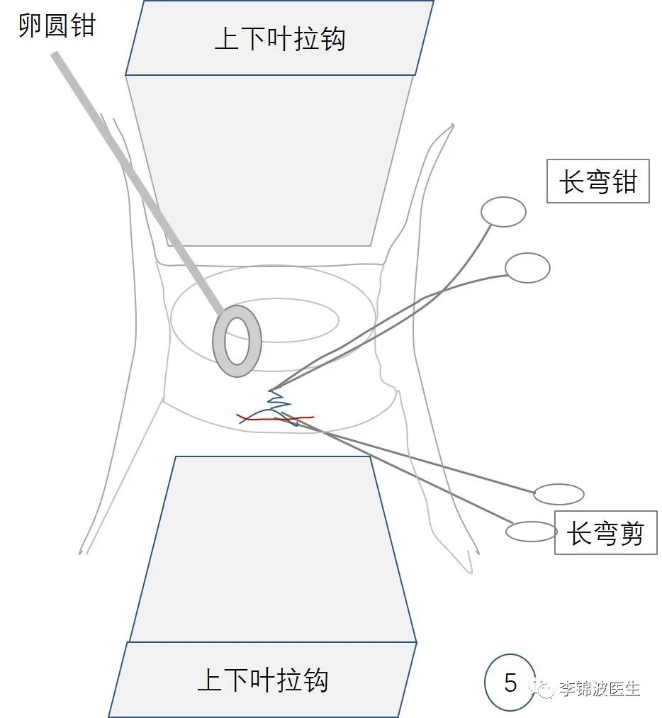 拆除高位宫颈环扎线的步骤和注意事项