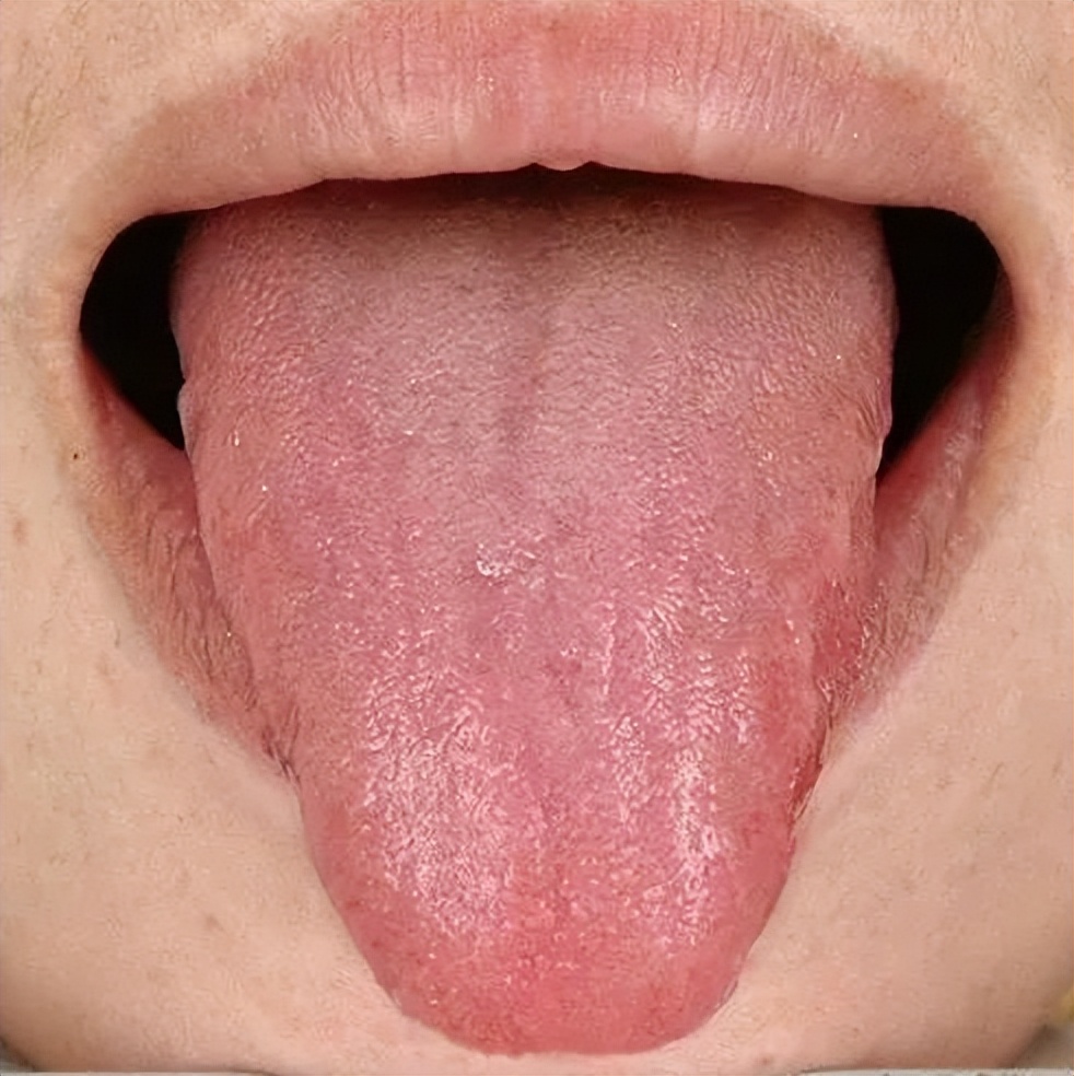 新冠的咳嗽是干咳还是有痰,我是新冠肺炎干咳无痰十几天了