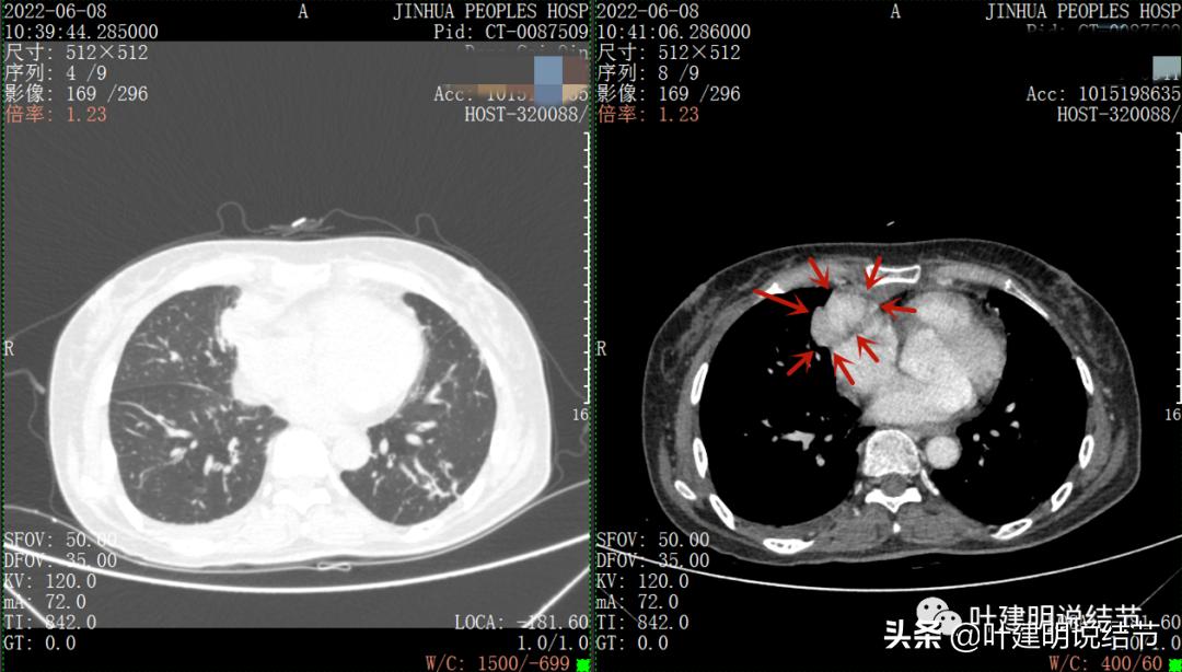 这位老乡，乏力来查，查出这么大个的纵隔肿瘤！会是什么呢？