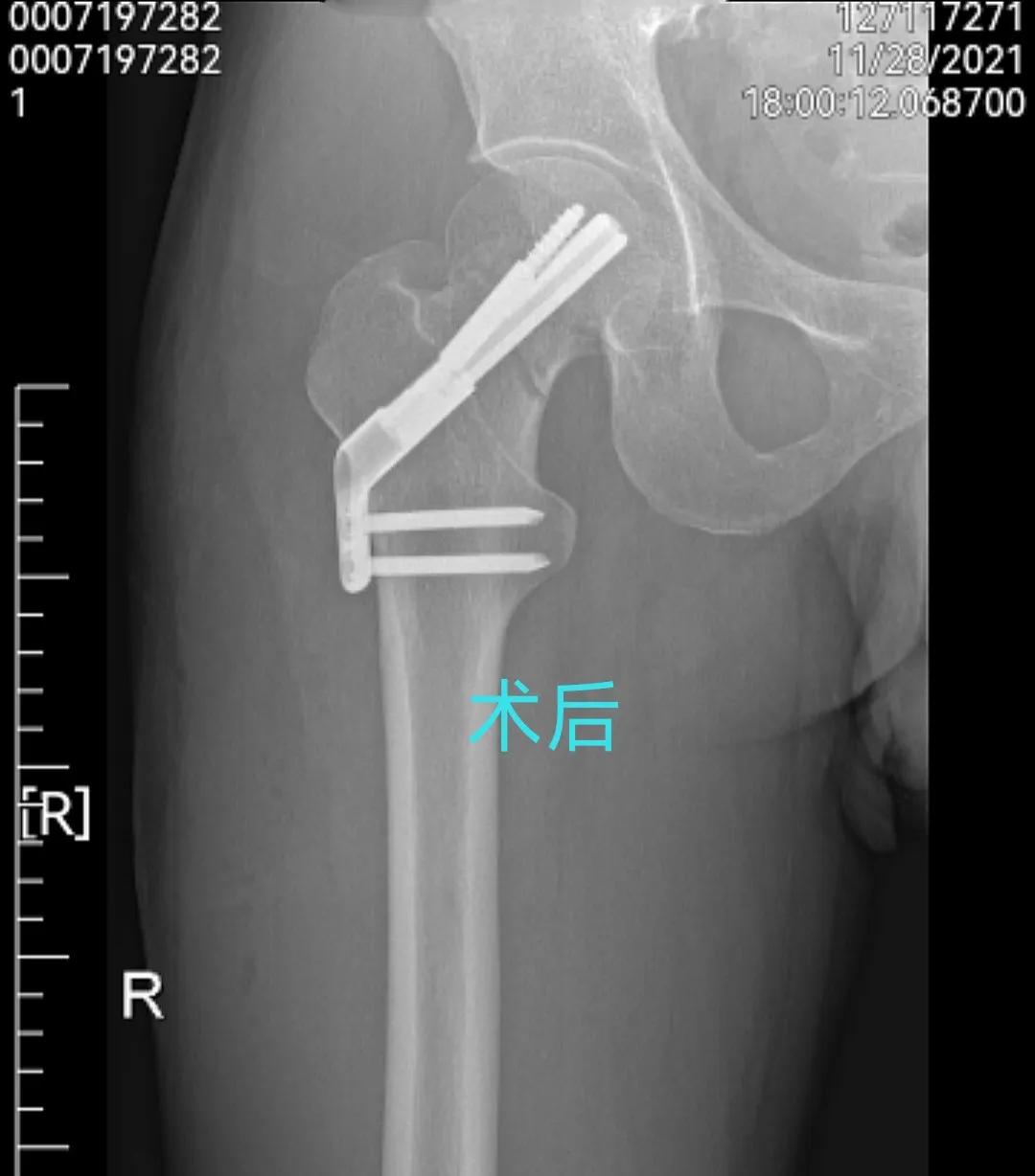 股骨颈骨折康复治疗,股骨颈骨折内固定康复