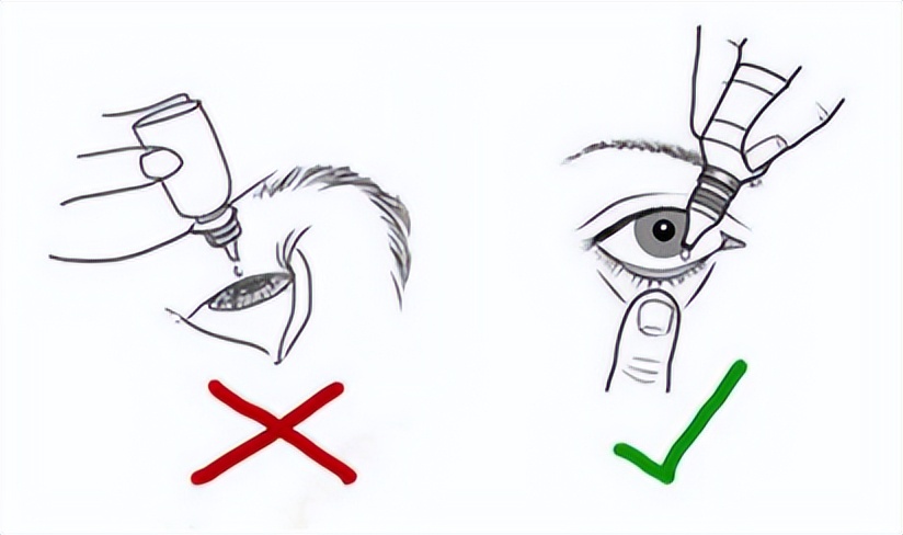 眼睛有红血丝用什么眼药水最佳,眼睛涩红血丝怎么办