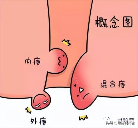 得了痔疮怎么办可以不动手术吗,不痛不痒的痔疮自愈的最佳方案