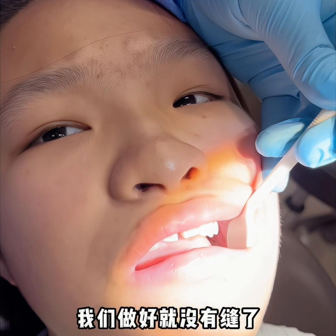 矫正牙齿拔牙开颌的全部过程,牙齿矫正拔牙后牙洞恢复过程图