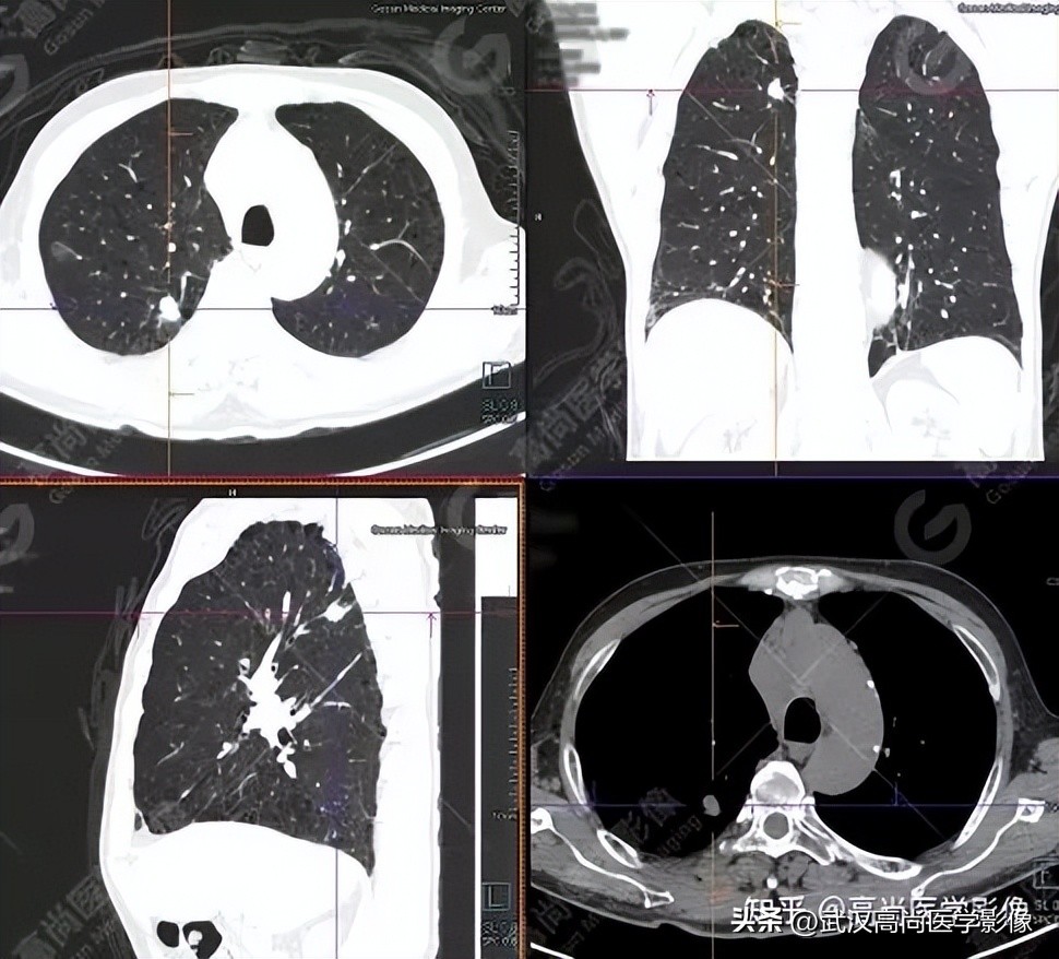 10毫米的肺结节恶性死亡率有多大,1厘米多的肺结节良性可能性多大