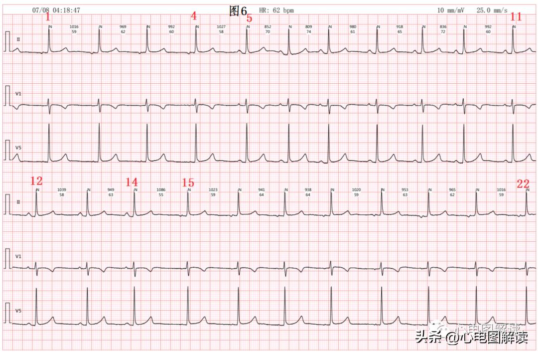窦房结游走心律的临床意义,窦房结游走心律心电图特征