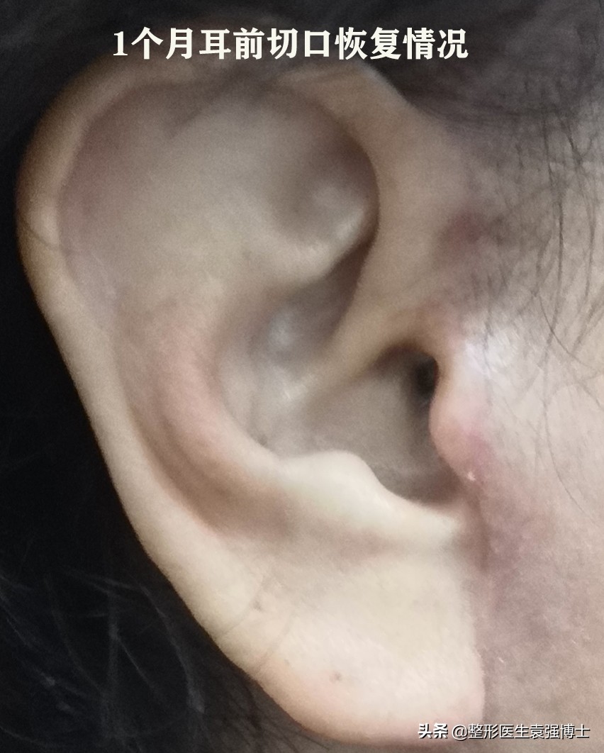 肚皮松弛拉皮手术有副作用吗,脸上做拉皮手术有无副作用