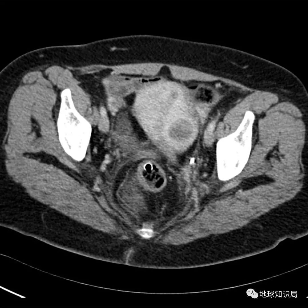 切除子宫的人会免疫力低吗,切除子宫的人寿命长吗