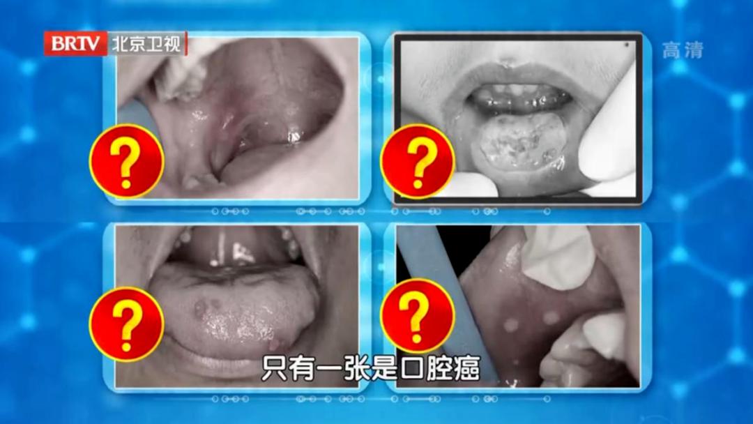 体内有癌嘴先知,体内有癌症嘴巴先知