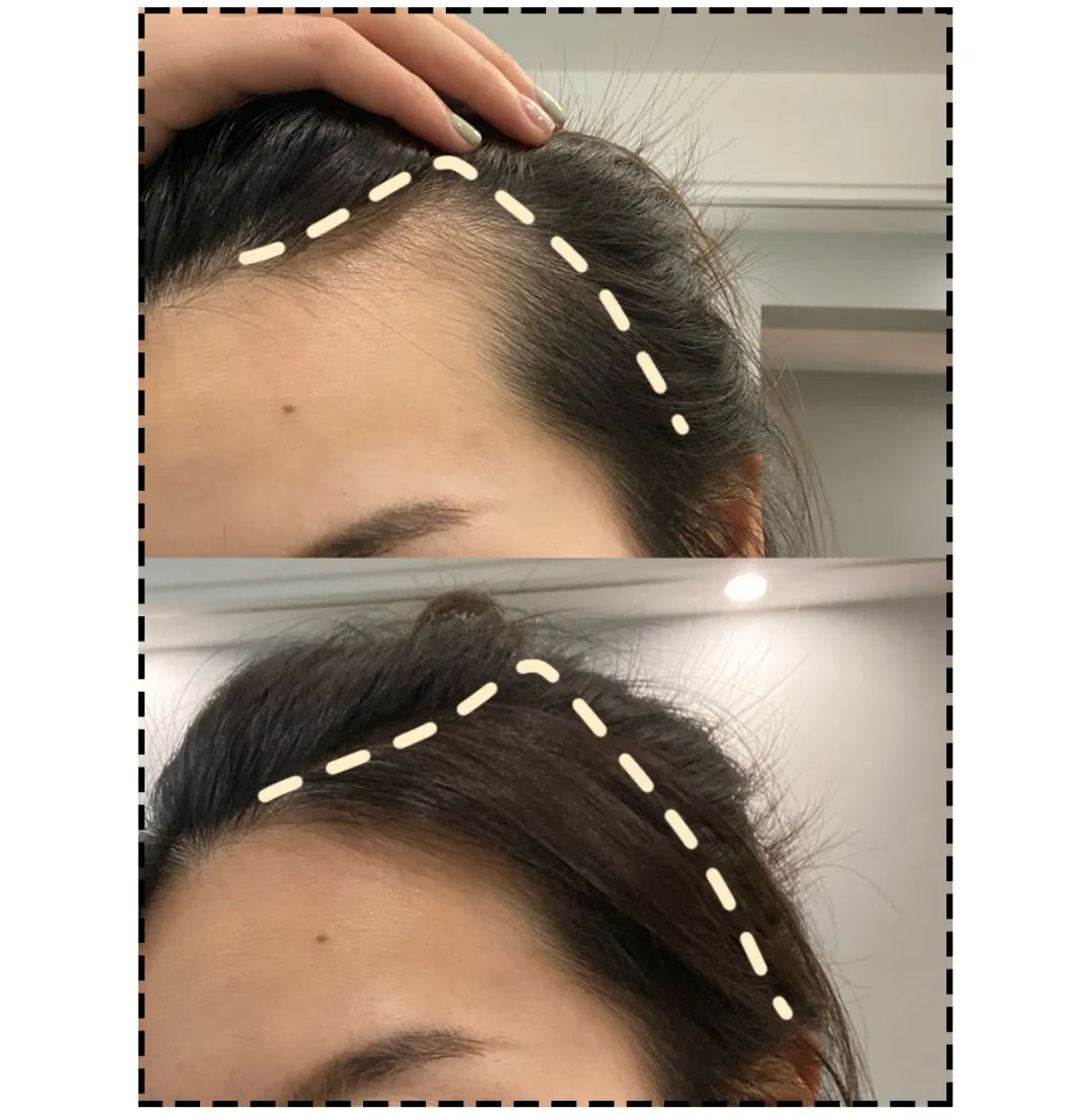 发际线高发量少怎么烫,发际线高发量少应该吃什么